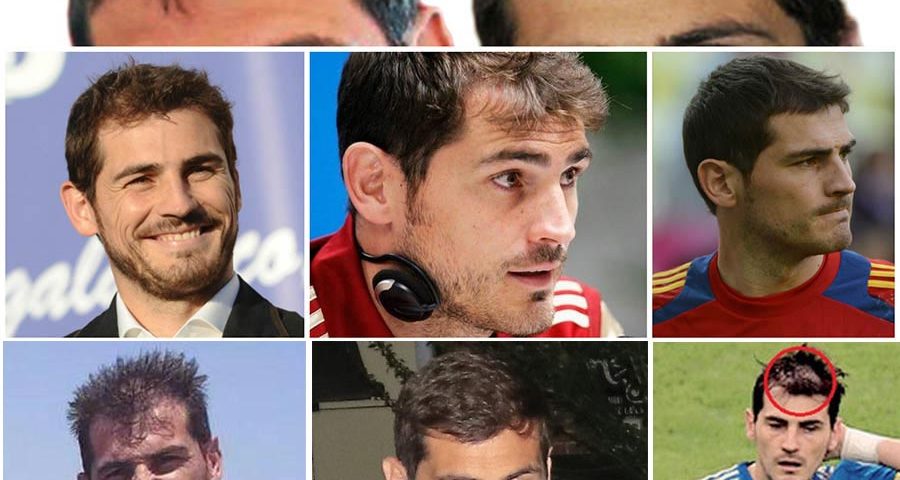 Iker Casillas trasplante capilar