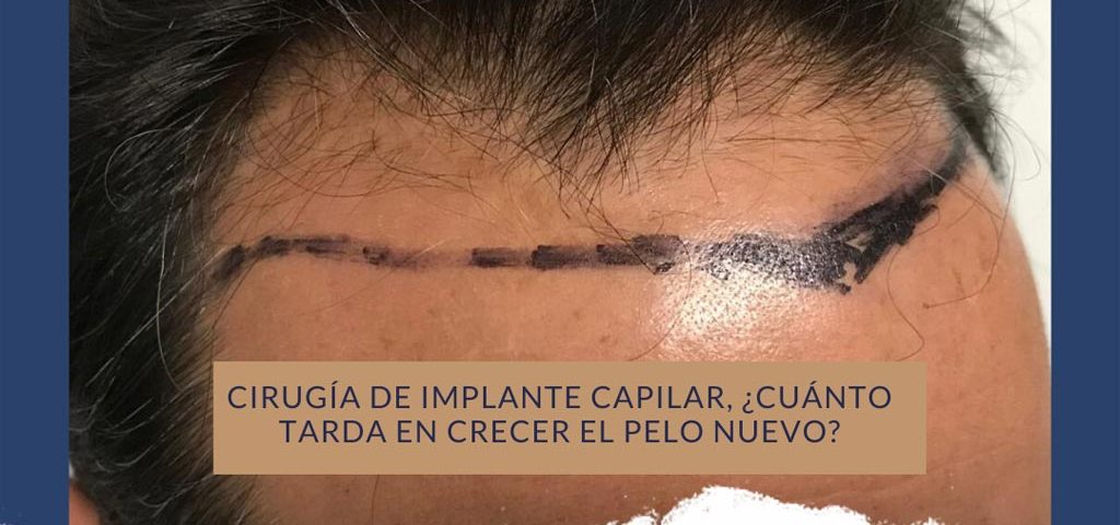 Implante Capilar