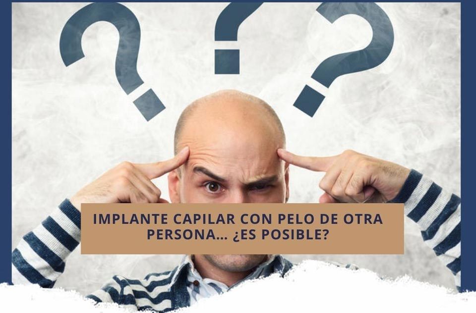 Implante capilar en Cali Colombia con pelo de otra persona… ¿es posible?
