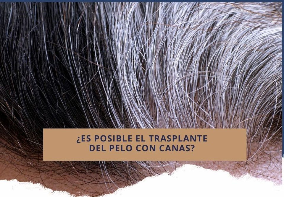 ¿Es posible el trasplante del pelo con canas?