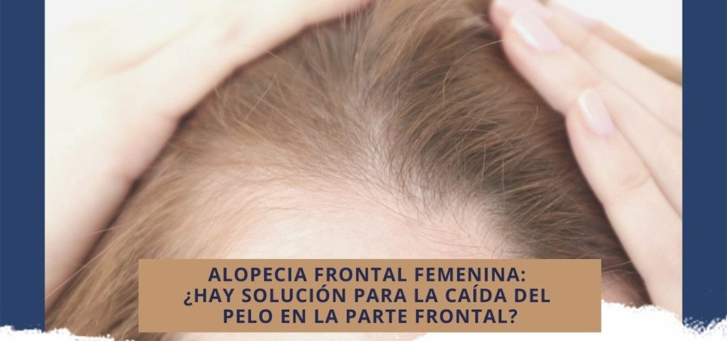 Alopecia frontal femenina