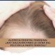 Alopecia frontal femenina