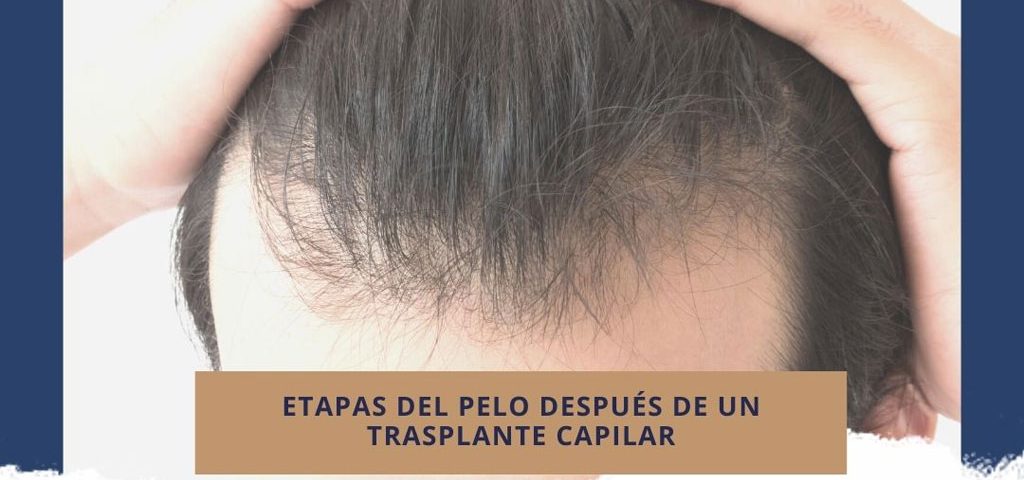 Etapas del pelo después de un trasplante capilar