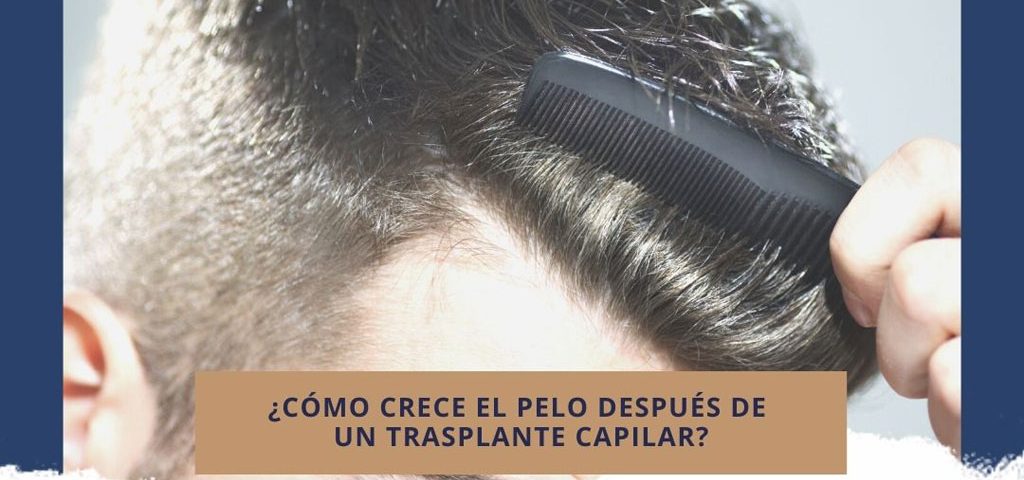 ¿Cómo crece el pelo después de un trasplante capilar?