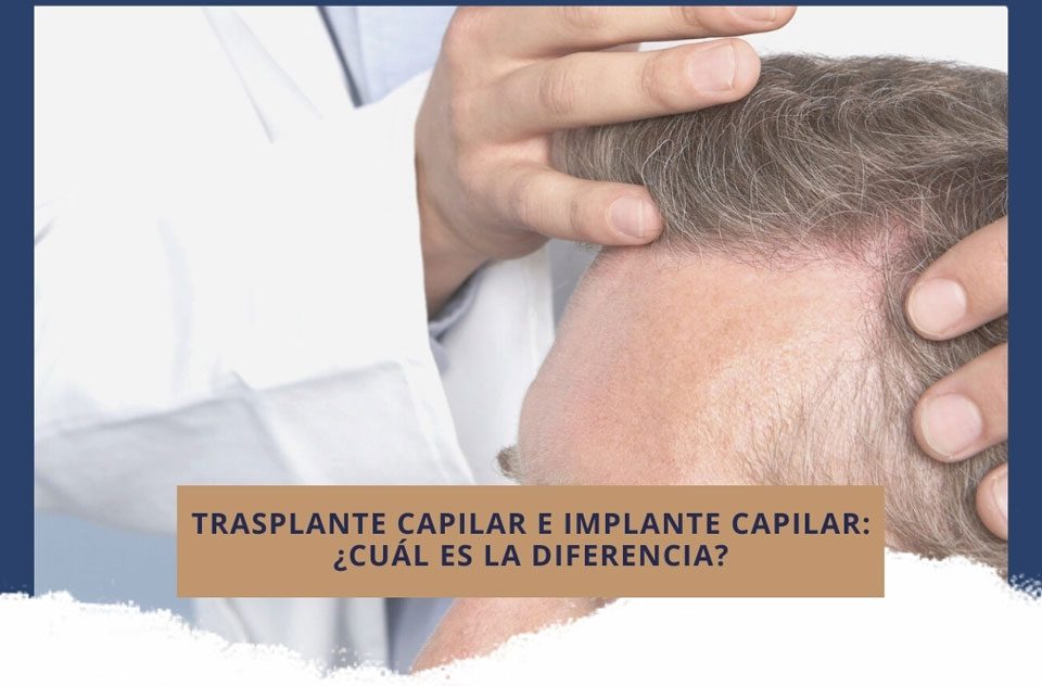Trasplante capilar e implante capilar: ¿cuál es la diferencia?